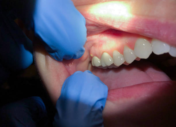 Best Emergency Gum Treatment in Pis, AR